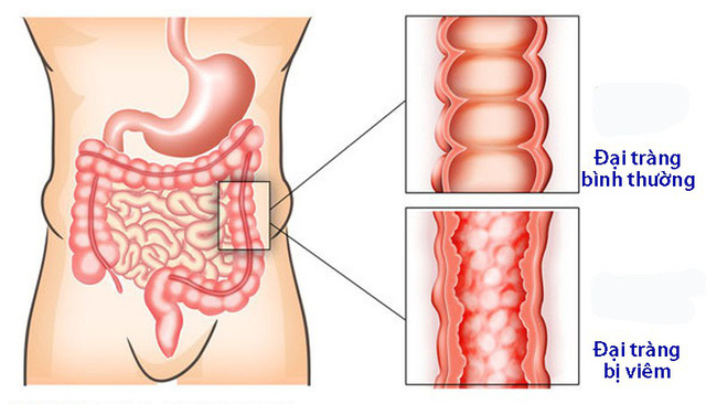 Người Lớn Bị Viêm Đại Tràng Có Nên Sử Dụng Men Vi Sinh Ramsun?